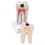 D10-4_01_Lower-Twin-Root-Molar-showing-cavities-2-part.jpg